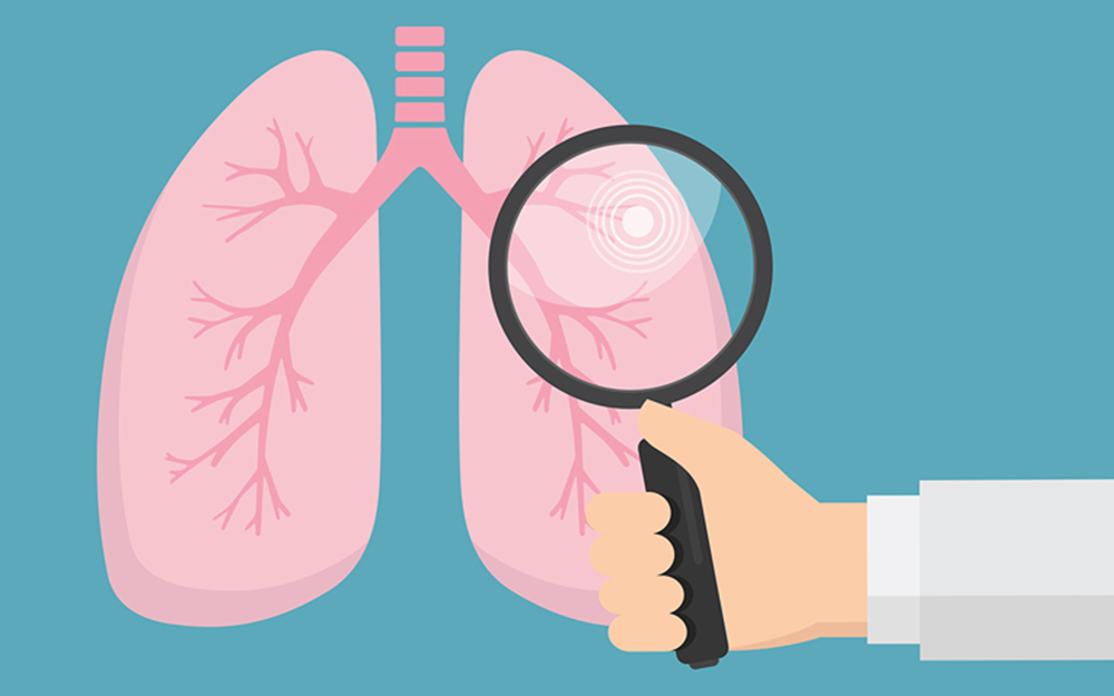 Lung-Cancer-Screening