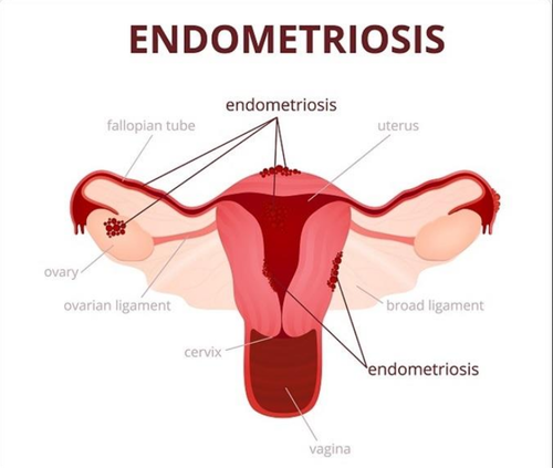 Endometriosis: Causes, Symptoms, Types, Treatment &#038; Risk Factors