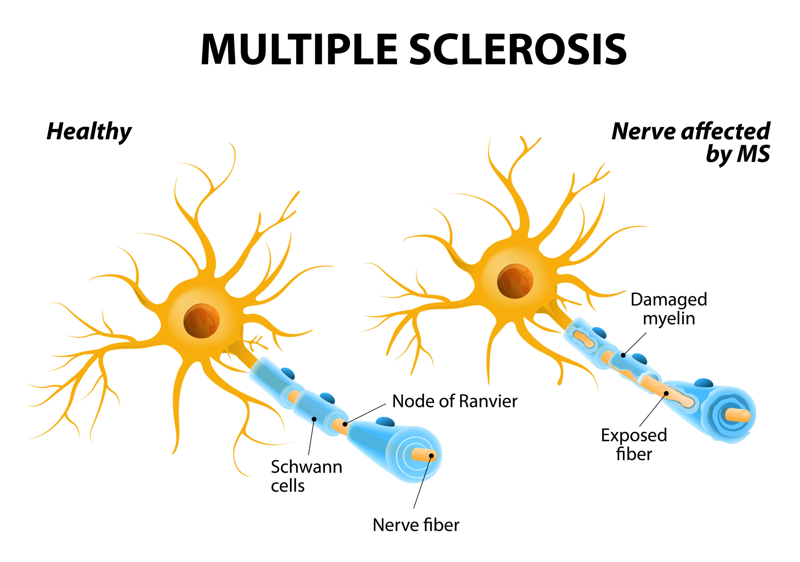 Multiple Sclerosis &#8211; Causes, Symptoms and Treatment