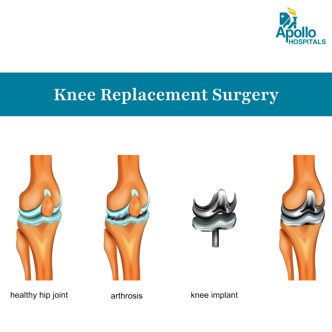 Knee Replacement Surgery