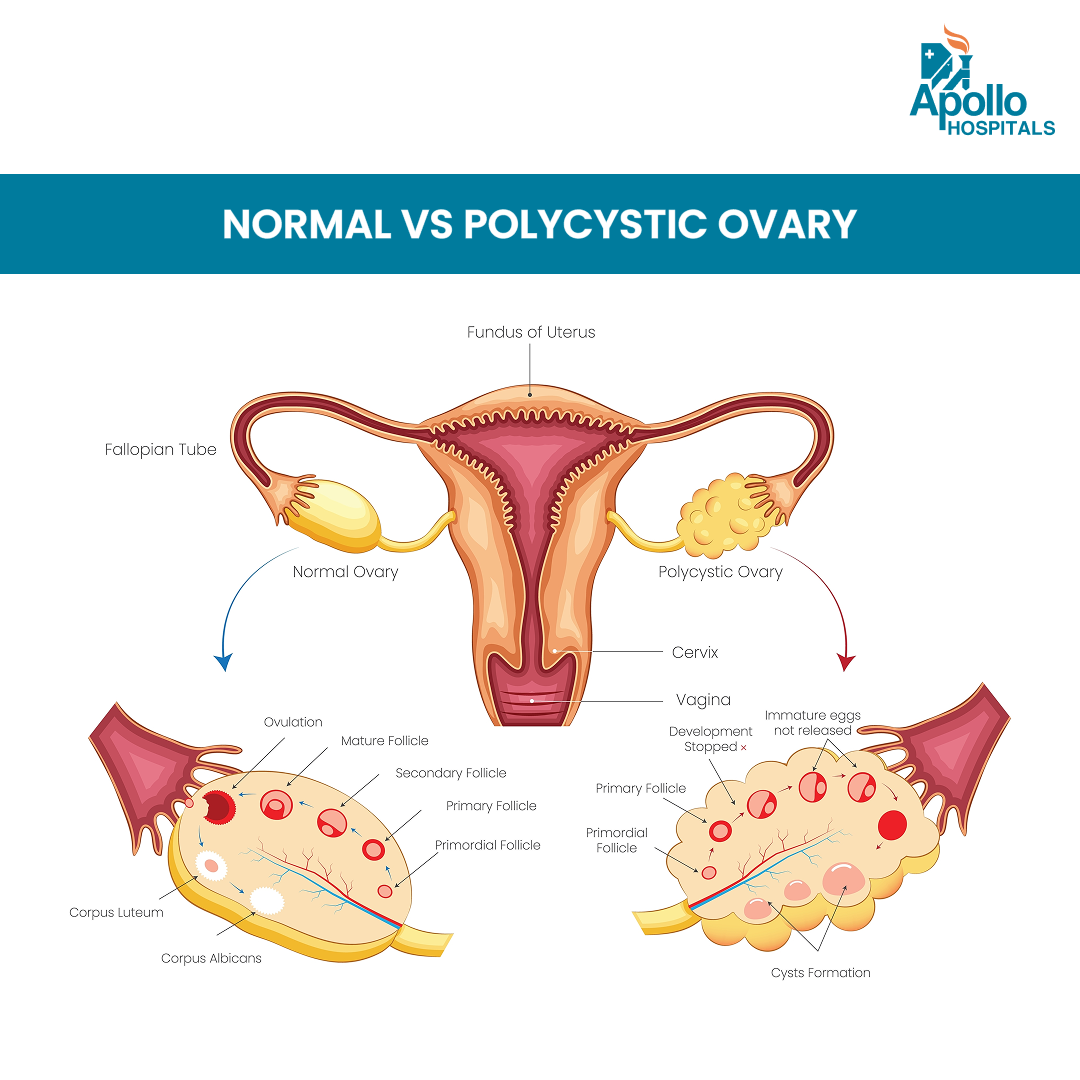 Polycystic Ovary