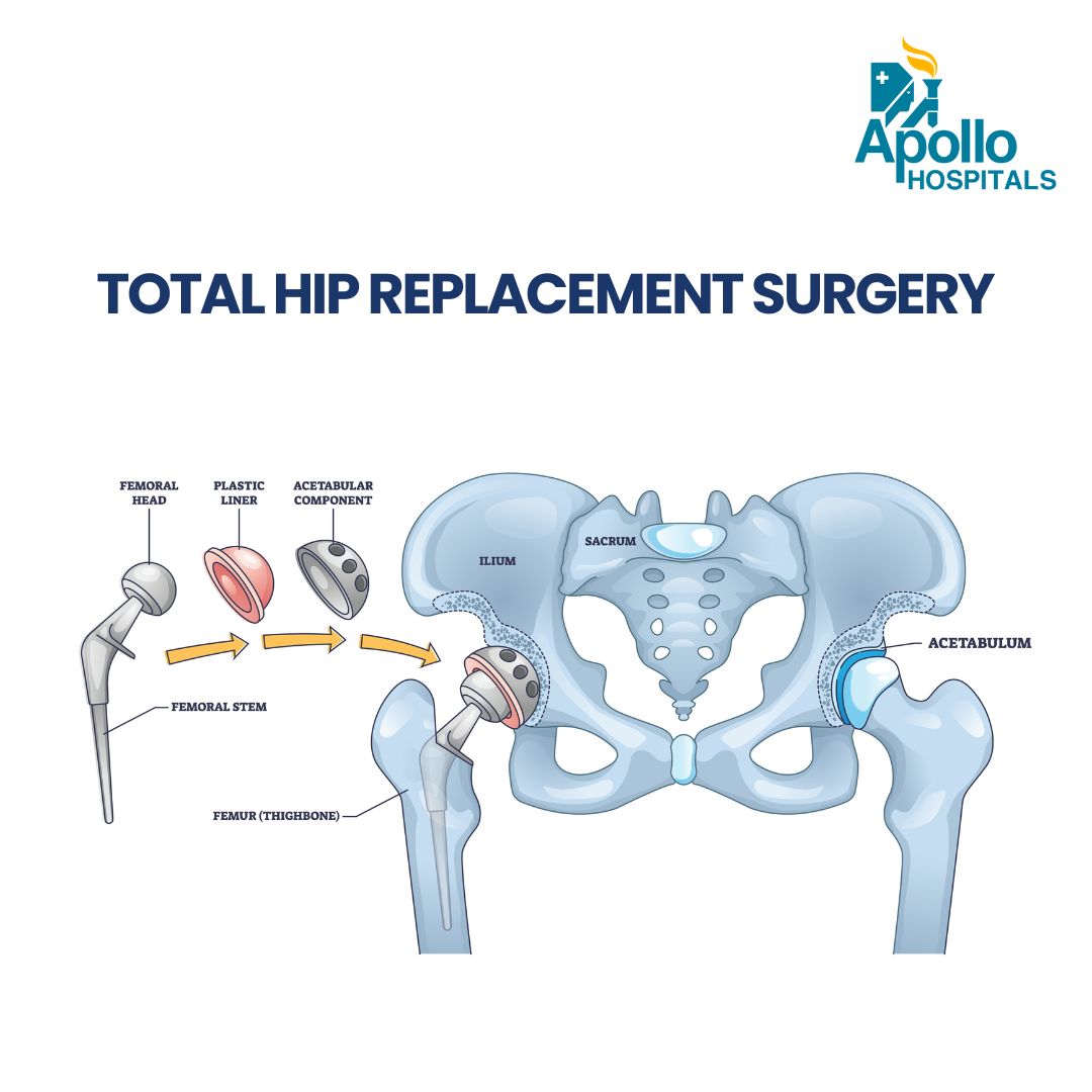 Total Hip Replacement (THR) Surgery